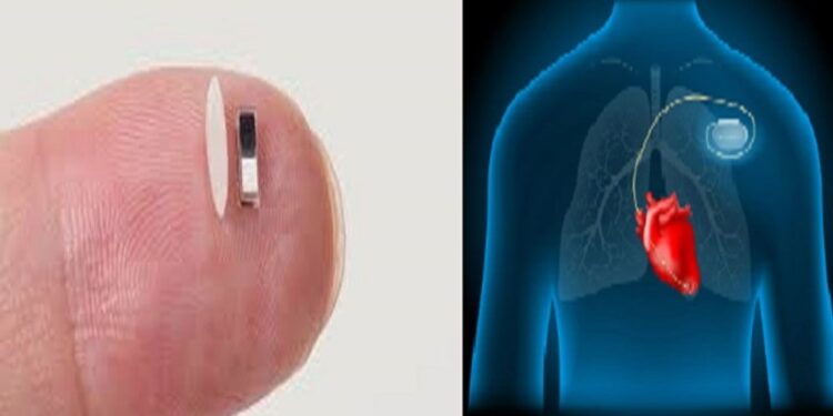 বিশ্বের ক্ষুদ্রতম পেসমেকার, কী আছে তাতে?